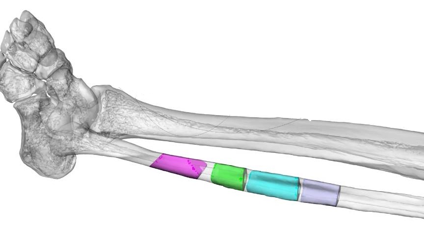 一毫米(1mm)的整形，上下顎骨3D列印重建