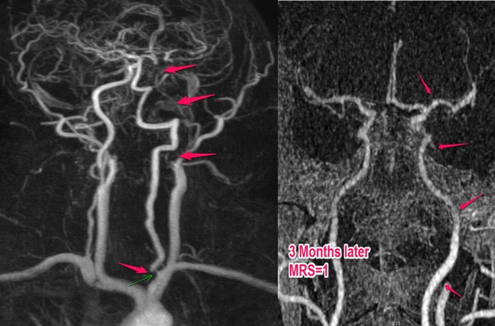 亞急性內頸動脈完全閉塞的兩階段再通治療