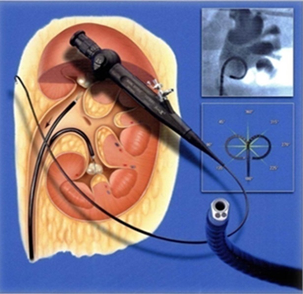 泌尿道結石治療中心－軟式輸尿管鏡手術介紹